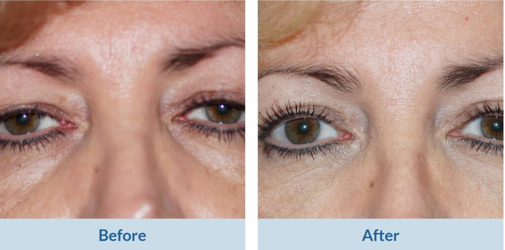 blepharoplasty before and after